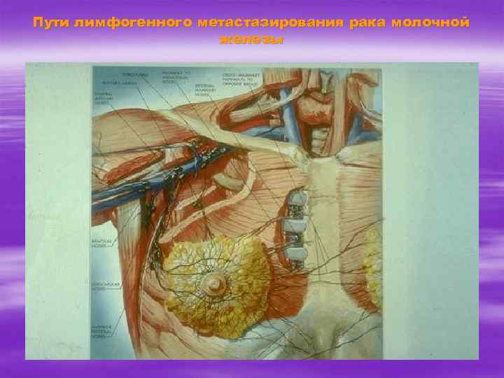 Пути лимфогенного метастазирования рака молочной железы 