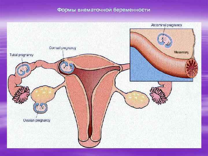 Формы внематочной беременности 