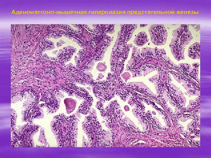 Аденоматозно-мышечная гиперплазия предстательной железы 