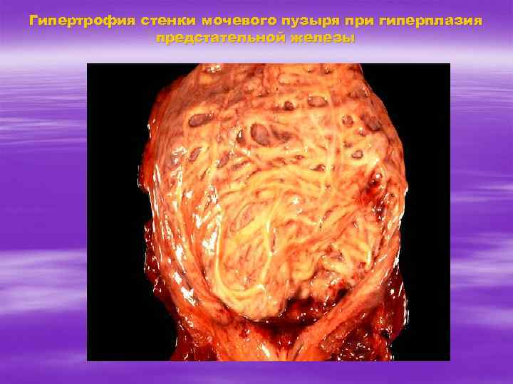 Гипертрофия стенки мочевого пузыря при гиперплазия предстательной железы 