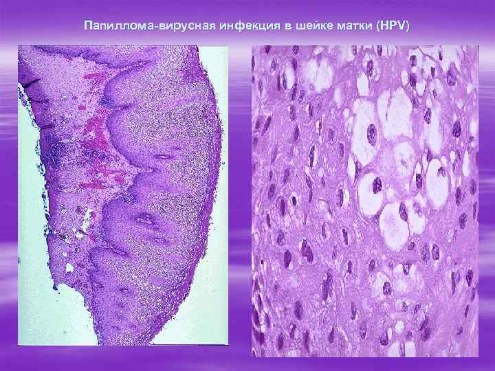 Папиллома-вирусная инфекция в шейке матки (HPV) 