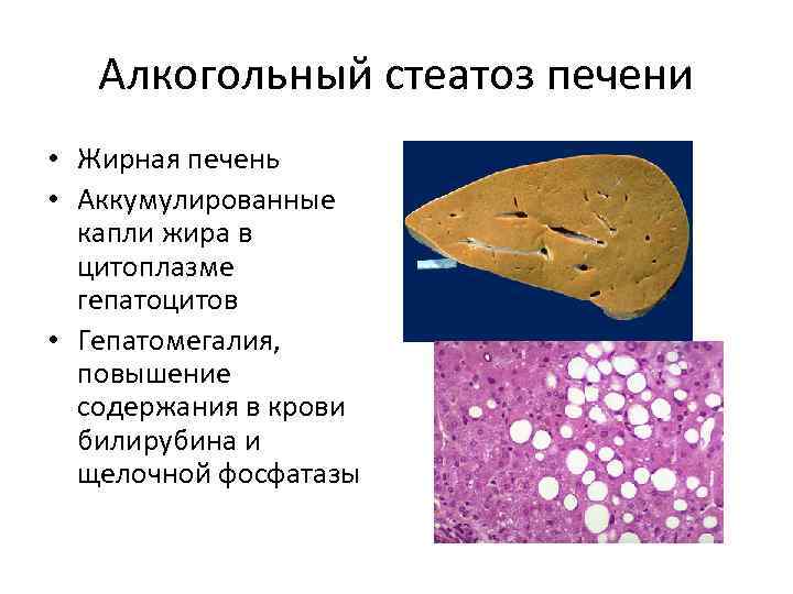 Алкогольный стеатоз печени • Жирная печень • Аккумулированные капли жира в цитоплазме гепатоцитов •