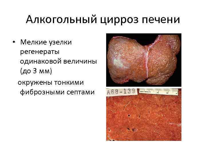 Алкогольный цирроз печени • Мелкие узелки регенераты одинаковой величины (до 3 мм) окружены тонкими