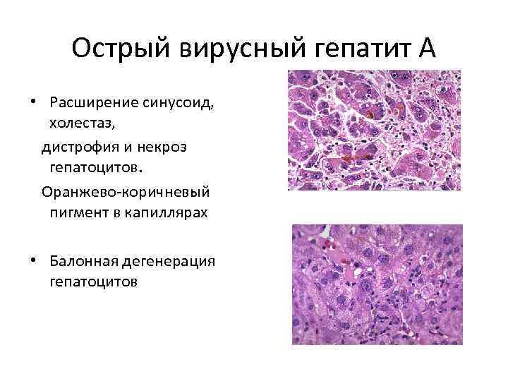 Острый вирусный гепатит А • Расширение синусоид, холестаз, дистрофия и некроз гепатоцитов. Оранжево-коричневый пигмент