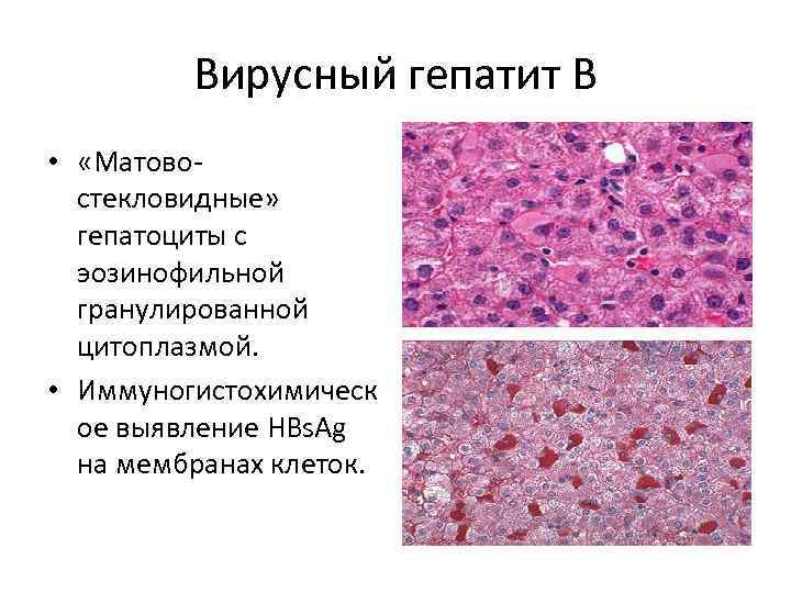 Вирусный гепатит В • «Матовостекловидные» гепатоциты с эозинофильной гранулированной цитоплазмой. • Иммуногистохимическ ое выявление