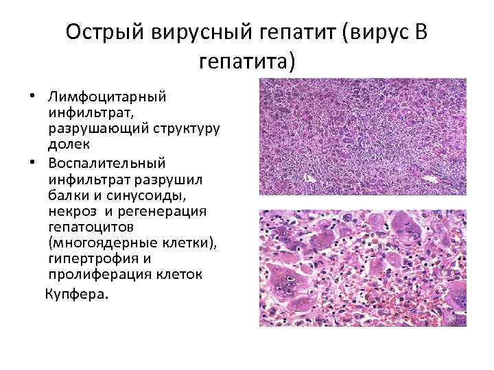 Острый вирусный гепатит (вирус В гепатита) • Лимфоцитарный инфильтрат, разрушающий структуру долек • Воспалительный