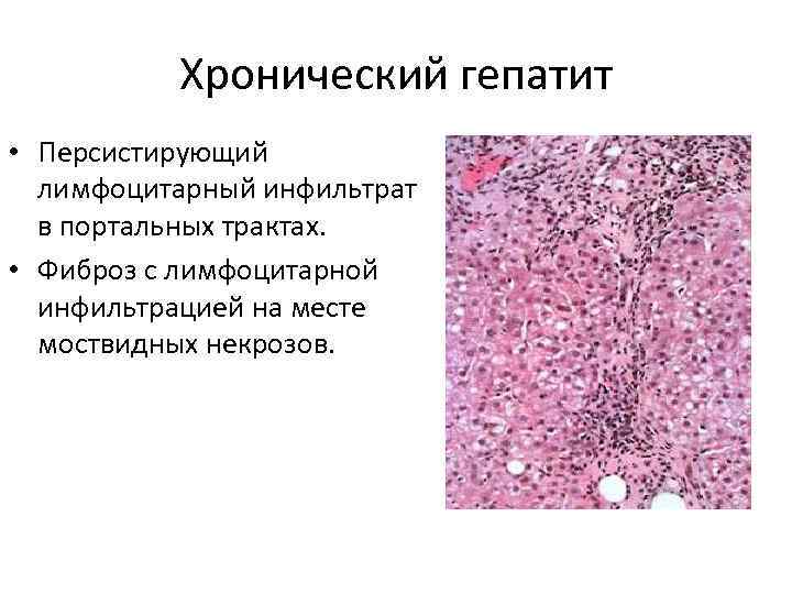 Хронический гепатит • Персистирующий лимфоцитарный инфильтрат в портальных трактах. • Фиброз с лимфоцитарной инфильтрацией