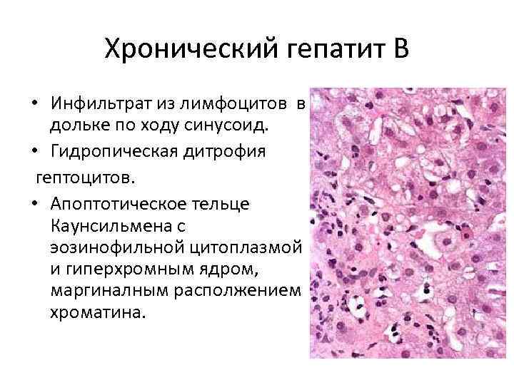 Хронический гепатит В • Инфильтрат из лимфоцитов в дольке по ходу синусоид. • Гидропическая