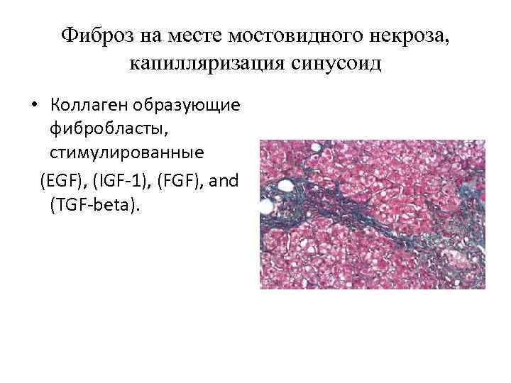 Фиброз на месте мостовидного некроза, капилляризация синусоид • Коллаген образующие фибробласты, стимулированные (EGF), (IGF-1),