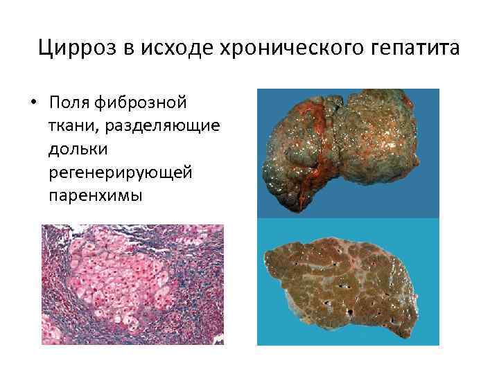 Цирроз в исходе хронического гепатита • Поля фиброзной ткани, разделяющие дольки регенерирующей паренхимы 