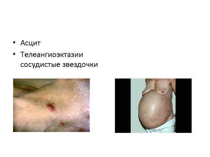  • Асцит • Телеангиоэктазии сосудистые звездочки 