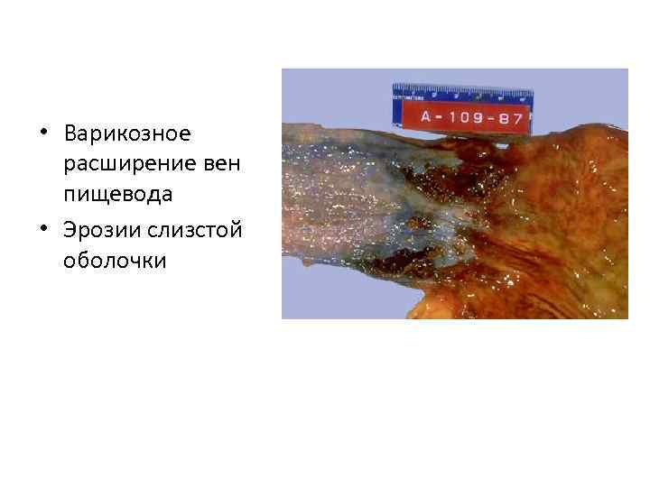  • Варикозное расширение вен пищевода • Эрозии слизстой оболочки 