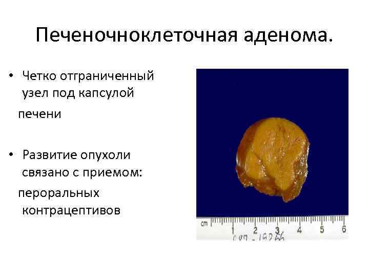 Печеночноклеточная аденома. • Четко отграниченный узел под капсулой печени • Развитие опухоли связано с