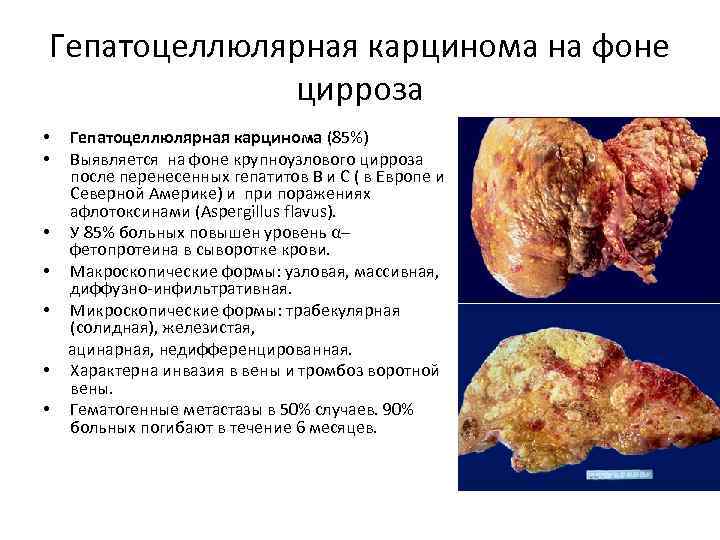 Гепатоцеллюлярная карцинома на фоне цирроза • • Гепатоцеллюлярная карцинома (85%) Выявляется на фоне крупноузлового