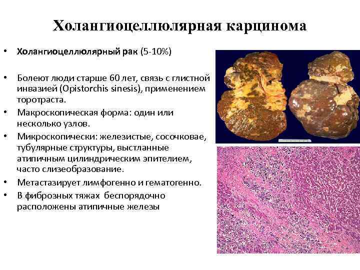 Холангиоцеллюлярная карцинома • Холангиоцеллюлярный рак (5 -10%) • Болеют люди старше 60 лет, связь