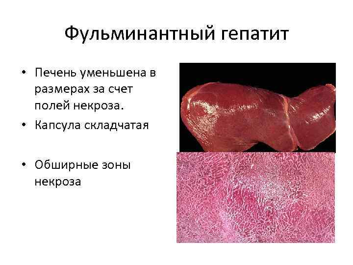 Фульминантный гепатит • Печень уменьшена в размерах за счет полей некроза. • Капсула складчатая