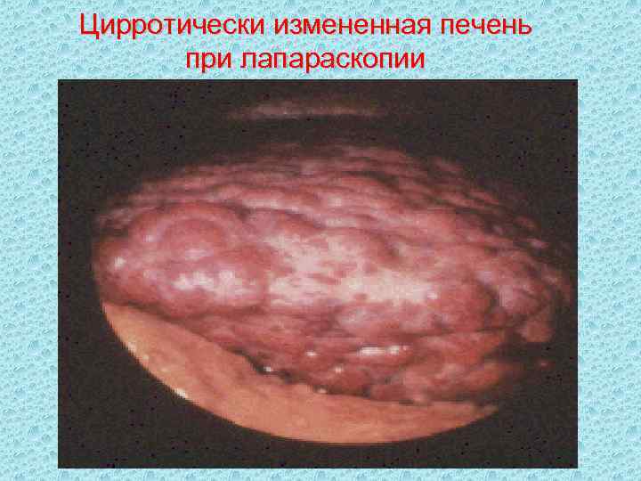 Цирротически измененная печень при лапараскопии 