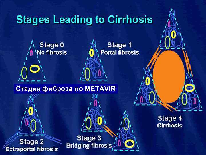Стадия фиброза по METAVIR 