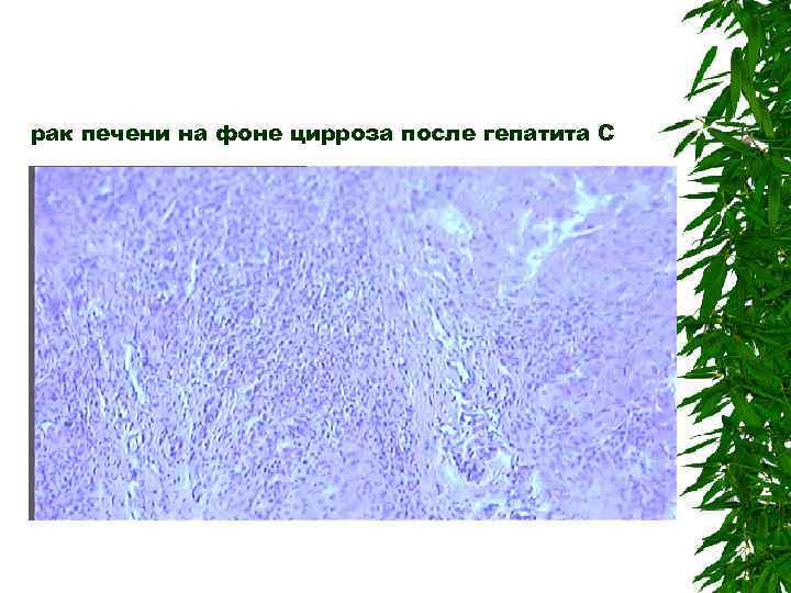 рак печени на фоне цирроза после гепатита С 