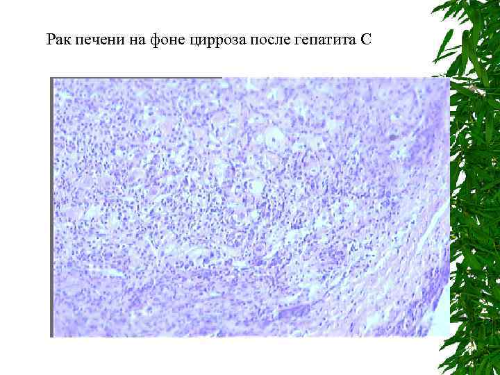 Рак печени на фоне цирроза после гепатита С 