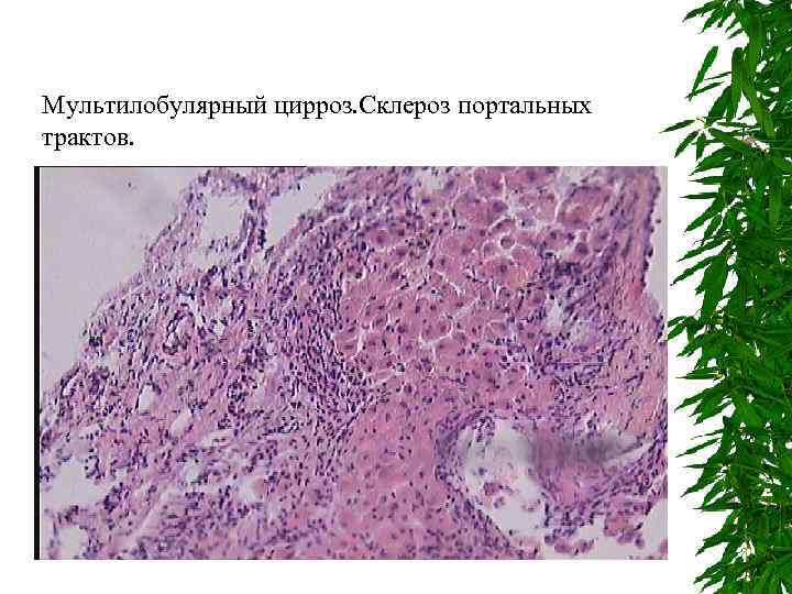 Мультилобулярный цирроз. Склероз портальных трактов. 