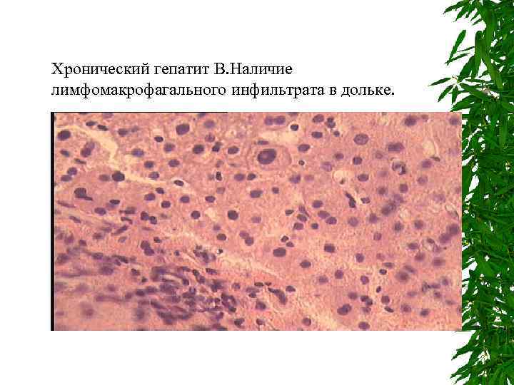 Хронический гепатит В. Наличие лимфомакрофагального инфильтрата в дольке. 