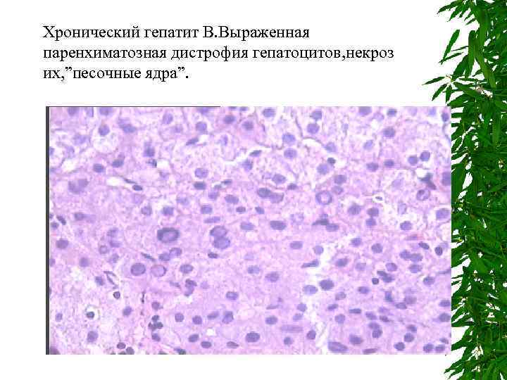 Хронический гепатит В. Выраженная паренхиматозная дистрофия гепатоцитов, некроз их, ”песочные ядра”. 