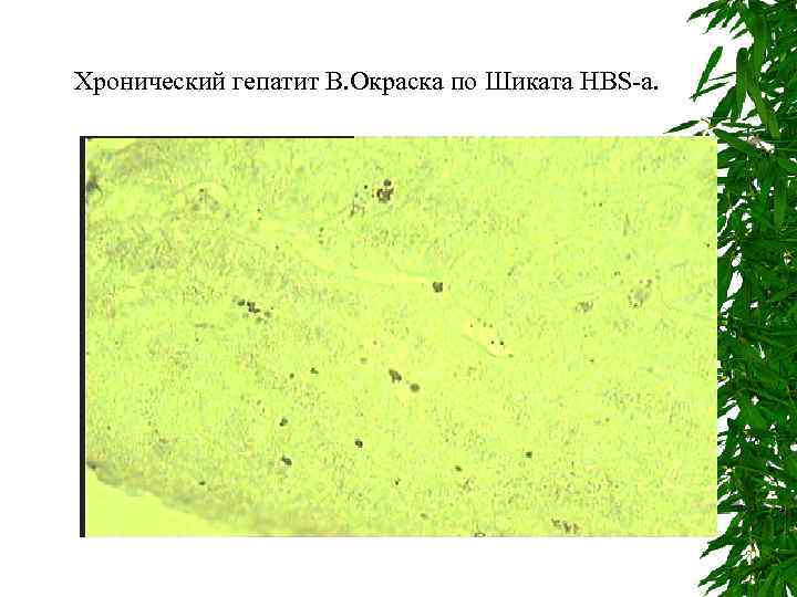 Хронический гепатит В. Окраска по Шиката HBS-а. 