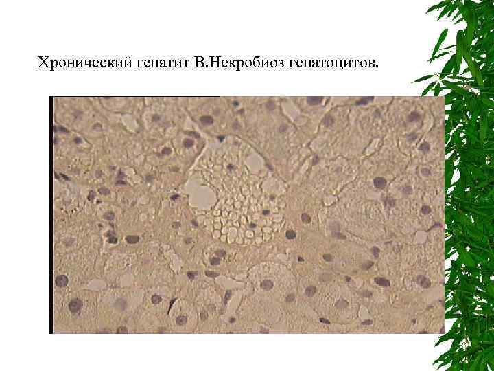 Хронический гепатит В. Некробиоз гепатоцитов. 