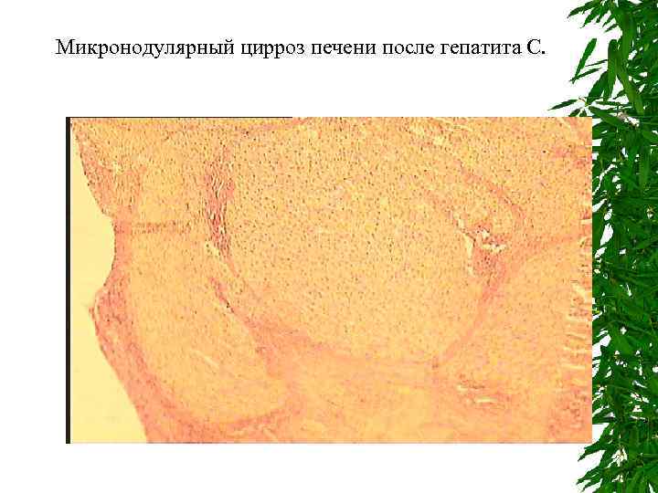 Микронодулярный цирроз печени после гепатита С. 
