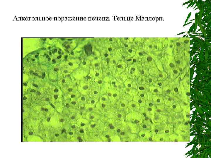 Алкогольное поражение печени. Тельце Маллори. 