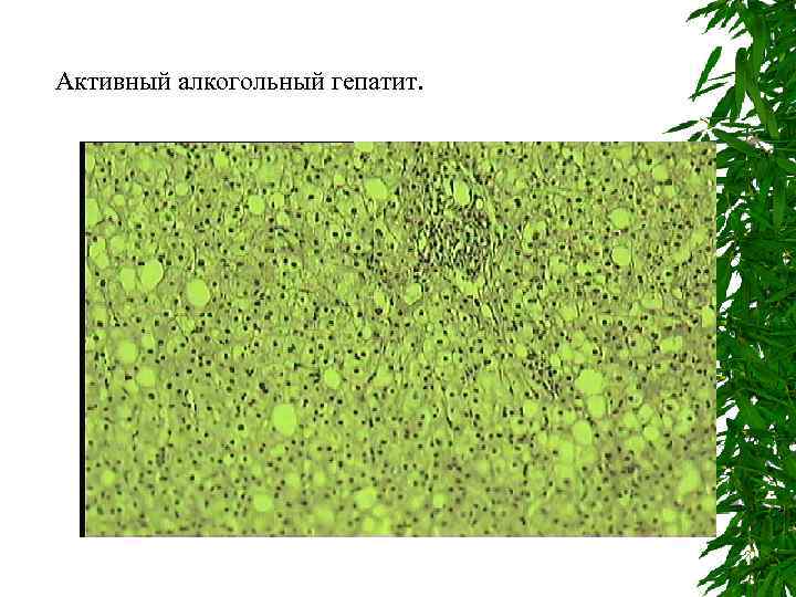 Активный алкогольный гепатит. 