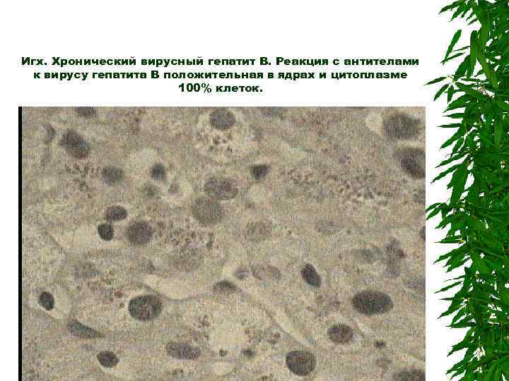 Игх. Хронический вирусный гепатит В. Реакция с антителами к вирусу гепатита В положительная в