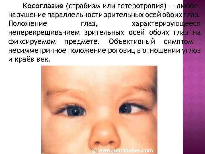 Косоглазие (страбизм или гетеротропия) — любое нарушение параллельности зрительных осей обоих глаз. Положение глаз,
