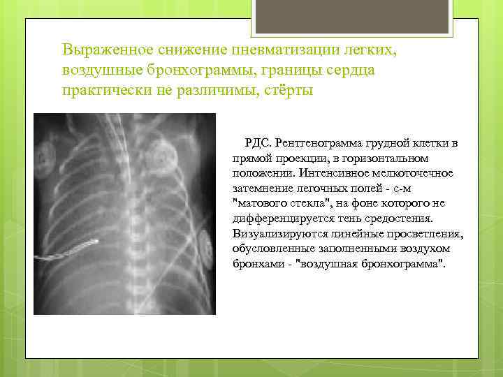 Выраженное снижение пневматизации легких, воздушные бронхограммы, границы сердца практически не различимы, стёрты РДС. Рентгенограмма