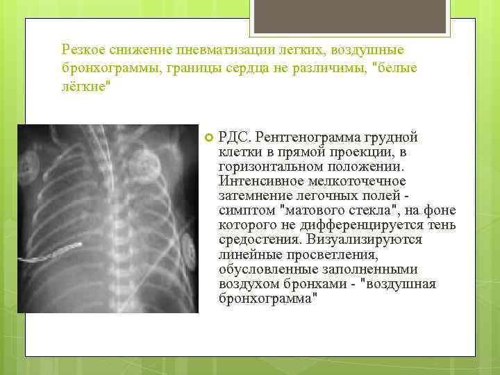 Резкое снижение пневматизации легких, воздушные бронхограммы, границы сердца не различимы, "белые лёгкие" РДС. Рентгенограмма