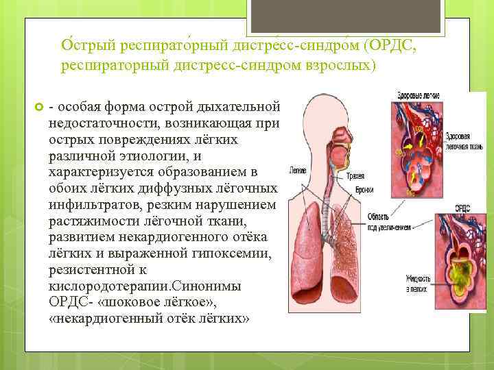 О стрый респирато рный дистре сс-синдро м (ОРДС, респираторный дистресс-синдром взрослых) - особая форма