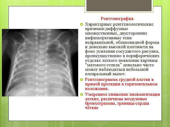  Рентгенография. Характерные рентгенологические признаки: диффузные множественные, двусторонние инфильтративные тени неправильной, облаковидной формы и