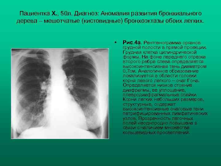 Пациентка Х. , 50 л. Диагноз: Аномалия развития бронхиального дерева – мешотчатые (кистовидные) бронхоэктазы