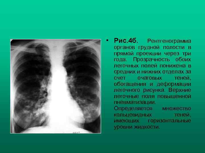  • Рис. 4 б. Рентгенограмма органов грудной полости в прямой проекции через три