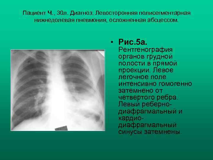 Пациент Ч. , 30 л. Диагноз: Левосторонняя полисегментарная нижнедолевая пневмония, осложненная абсцессом. • Рис.