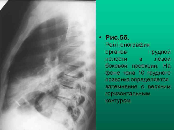  • Рис. 5 б. Рентгенография органов грудной полости в левой боковой проекции. На