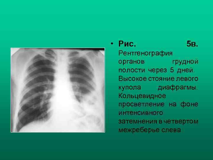  • Рис. 5 в. Рентгенография органов грудной полости через 5 дней. Высокое стояние