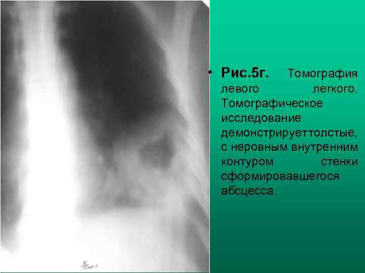  • Рис. 5 г. Томография левого легкого. Томографическое исследование демонстрирует толстые, с неровным