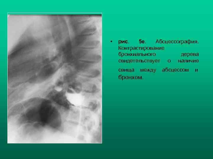  • рис. 5 е. Абсцессография. Контрастирование бронхиального дерева свидетельствует о наличие свища между