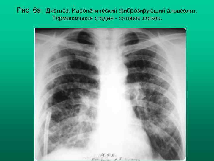 Рис. 6 а. Диагноз: Идеопатический фиброзирующий альвеолит. Терминальная стадия - сотовое легкое. Н. С.