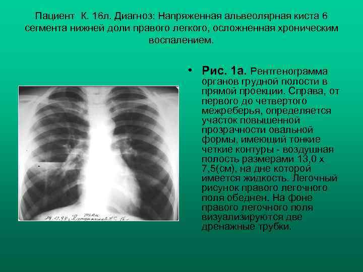 Пациент К. 16 л. Диагноз: Напряженная альвеолярная киста 6 сегмента нижней доли правого легкого,