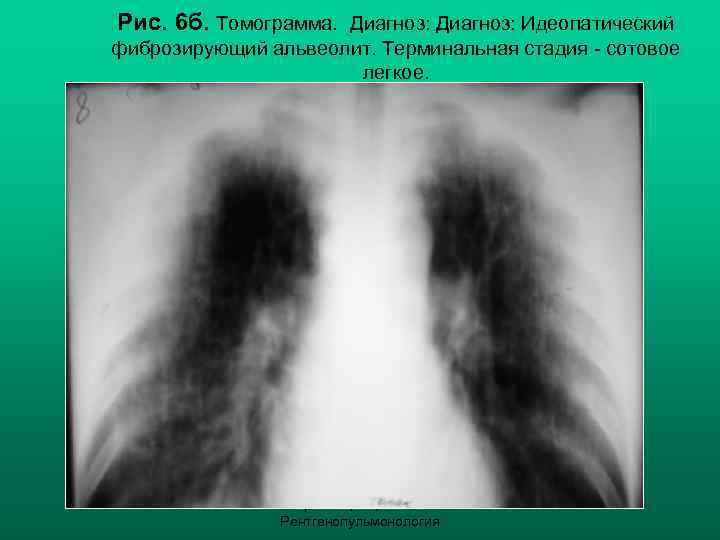 Рис. 6 б. Томограмма. Диагноз: Идеопатический фиброзирующий альвеолит. Терминальная стадия - сотовое легкое. Н.