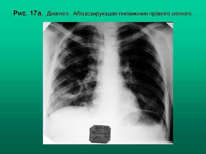 Рис. 17 а. Диагноз: Абсцедирующая пневмония правого легкого. 