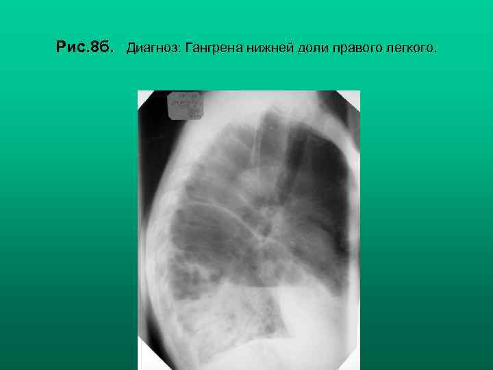 Рис. 8 б. Диагноз: Гангрена нижней доли правого легкого. Н. С. Воротынцева, С. С.